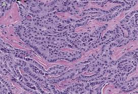 Sarcomatoid mesothelioma accounts are the least common of the mesothelioma cell types. Diagnosis Of Mesothelioma Surgical Pathology Clinics