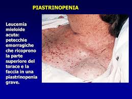 Cos'è e quali sono le cause che provocano l'alterazione del ciclo mestruale. Leucemie Sono Tumori Maligni Del Sistema Emolinfopoietico Ppt Scaricare