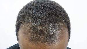 If you know you're not living your healthiest life, there are steps that can have an impact on hair loss. What Black Men Should Do About Thinning Hair Mrcottontop