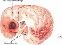 Just Three Months Into A Large Multicenter Clinical Trial Evaluating Combining Aspirin And The Antiplatelet Dru Medical School Stuff Medical Training Neurology