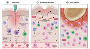 Image result for Pathergy