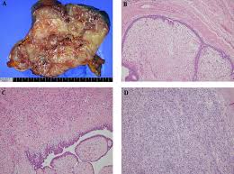 The malignant phyllodes tumor is rare with a lower incidence than the benign counterpart. Benign Phyllodes Tumor Of The Breast Recurring As A Rapidly Growing Recurrent Malignant Phyllodes Tumor A Case Report Iranian Journal Of Radiology Full Text