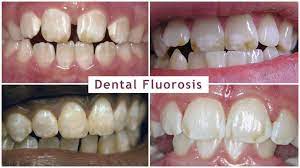 Fluoride Exposure And Human Health Risks Iaomt