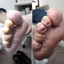 Image result for Onychogryphosis feet