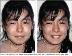 Image result for Tetany