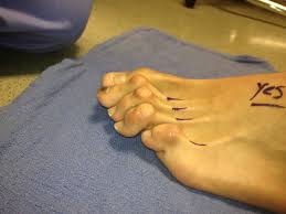 By avoiding large incisions, less soft tissue, such. Hammertoe Surgery Best Podiatrist Nyc Lawrence Silverberg Dpm 20 E 46th St New York Ny 10017 The Best Bunion Surgery Hammertoe Surgery In Nyc