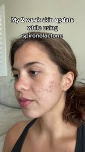 Acne Treatment Update: 2 Weeks Progress with Clindamycin and Spironolactone  Cream