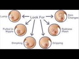 What are the signs and symptoms of colorectal cancer? Breast Cancer à¤¸ à¤¤à¤¨ à¤• à¤¸à¤° Ú†Ú¾Ø§ØªÛŒ Ú©Ø§ Ú©ÛŒÙ†Ø³Ø± Infection Control Health Icsp94 Udru Hindi 6 Youtube