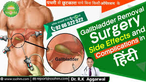 Gallbladder Removal Surgery Side Effects And Complications In Hindi D Gallbladder Removal Surgery Gall Bladder Removal