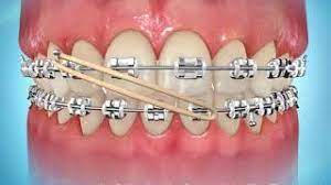 Even though teeth braces are made and designed by experts, people are trying to make them at their homes. Elastics Orthodontic Specialists Llc St George Ut