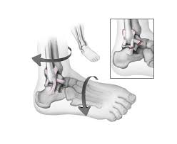 The inversion ankle sprain is the most common type of sprain and occurs when the foot falls inward and stretches the outer ligaments too far. Sprained Ankle Orthoinfo Aaos