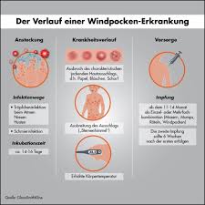 Da das unreife immunsystem des babys das virus nicht abwehren kann, kann es insbesondere bei kindern, die zwischen dem fünften und dem zehnten lebenstag erkranken, zu. Windpocken Zahl Der Erkrankungen Immer Noch Zu Hoch Neue Pressemitteilungen De