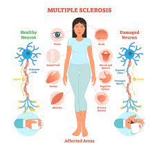 Problems in speech (dysarthria) or swallowing (dysphagia), visual problems. Symptoms Of Multiple Sclerosis You Can T See Sheltering Arms