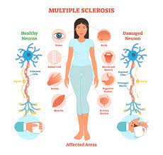 In multiple sclerosis (ms), damage to the myelin coating around nerve fibers in the central nervous system interferes with the transmission of nerve signals between the brain and spinal cord and other parts of the body. Symptoms Of Multiple Sclerosis You Can T See Sheltering Arms