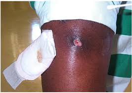 Consult a doctor for medical advice. Methicillin Resistant Staphylococcus Aureus Mrsa Public Information Orange County California Health Care Agency