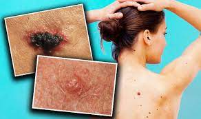 What are the signs and symptoms of skin cancer? Skin Cancer Symptoms Signs Of Melanoma And Non Melanoma Risk Factors Revealed Express Co Uk