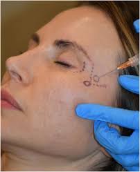 Image result for Forehead Regional Block