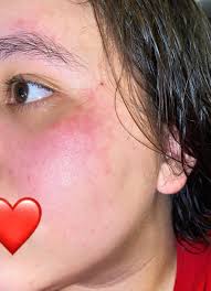 I have a white discoloration