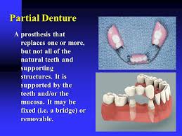 Partially edentulous patients choose this denture when they cannot have a bridge or dental implants. Introduction To Removable Partial Prosthodontics Ppt Video Online Download