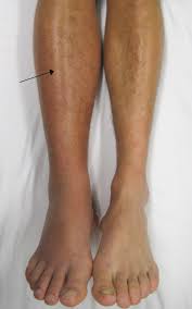 Deep Vein Thrombosis Wikipedia