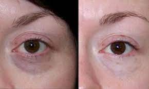 Does vitamin k reduce dark circles under eyes? Winter Ages A Woman S Eyes By Nearly Five Years As Vitamin D And Happy Hormone Levels Drop Daily Mail Online