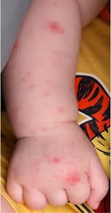 Heightened suspicion for pf secondary to meningococcemia is essential in patients presenting with diffuse maculopapular rash in the setting of severe sepsis/septic shock. Meningococcal Disease Clinical Presentation And Sequelae Sciencedirect