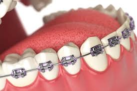 What type of dental insurance plan do you have and is orthodontic care included in it? Metal Braces Lombard Il Illinois Cost Handcrafted Smiles