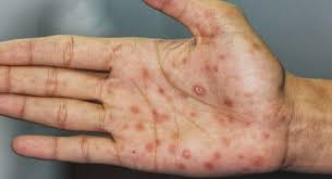 AIDS होने पर स्किन में तुंरत आ जाते हैं ये 4 बदलाव, समय रहते पहचानें इन्हें  