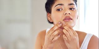 They last for months or even years. How To Get Rid Of Milia Causes Treatments From A Dermatologist