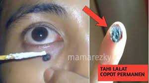 Membantu anda menyelesaikan masalah berkaitan tahi lalat, kutil, ketuat dan biji kolestrol. 100 Berhasil Cara Paling Jitu Membuang Tahi Lalat Secara Cepat Dan Alami Youtube