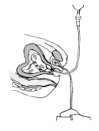 Image result for Uterine Inversion