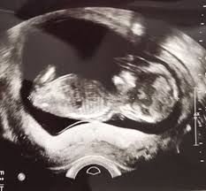 Wie gernot andeutet, taucht das geschlecht in solchen wendungen wieder auf. Ultraschallbilder Mehr Als 50 Bilder Aus Der Schwangerschaft Faminino