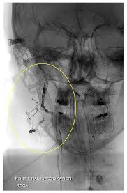 Here you will find one or more explanations in english for the word embolotherapy. Jcm Free Full Text The Use Of Transarterial Approaches In Peripheral Arteriovenous Malformations Avms Html