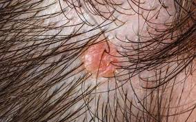 Image result for folliculitis symptoms