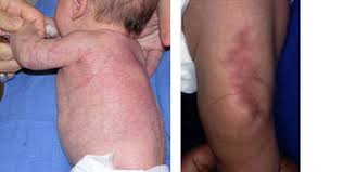 You will most often notice skin mottling after you give baby a bath. Cutis Marmorata Telangiectatica Congenita