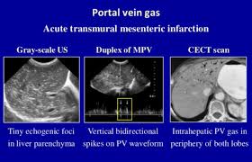 Portal Vein Gas Human Anatomy And Physiology Vascular Ultrasound Ultrasound Sonography