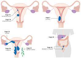 Early signs of endometrial cancer include: Endometrial Cancer Risk Factors Staging Surgery Teachmeobgyn