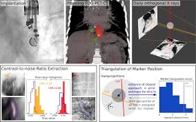 They are tiny, smaller than a … Utility Of Fiducial Markers For Target Positioning In Proton Radiotherapy Of Oesophageal Carcinoma Radiotherapy And Oncology