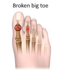 Surgery on a broken toe nail a man. Broken Big Toe Causes Symptoms Diagnosis And Treatments The Health Experts