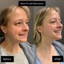 A simple injection of Dysport or Botox in the neck and jawline to contour  the jawline and soften the platysma! Results last 3-4 months!