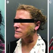 Photographs of rhytidectomy patients