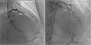 There are termed diagonal due to them branching from their parent vessel at acute angles. Cardiovascular Medicine Unusual Collateralisation Of A Chronic Total Occlusion Of The Left Anterior Descending Artery