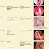 Myringotomies for chronic ear infections, also called glue ear, is less common in adults. Https Encrypted Tbn0 Gstatic Com Images Q Tbn And9gcsxhp2cyehubrbcg N Cozmbzjmnq8f9qbyup4edqgazcclb7ab Usqp Cau