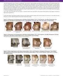 Motiva Implant Matrix Silicone Breast Implants Summary Of