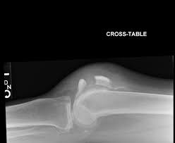 Patella Fracture Radiology Radiology Technologist Medical Photos