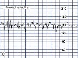 Image result for FHR Variability