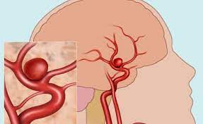 Um aneurisma é o resultado de uma parede arterial enfraquecida. O Que E Um Aneurisma Cerebral Midia Bahia