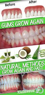 Make Receding Gums Grow Again And Fast With These Natural Methods Touch Of The Nature Receding Gums Gum Care Gum Health