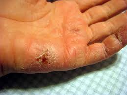 Maybe you would like to learn more about one of these? 15 Best Natural And Essential Oils To Heal Eczema Conserve Energy Future
