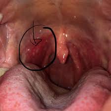 Ist Das Herpes Am Gaumen Gesundheit Und Medizin Medizin Arzt